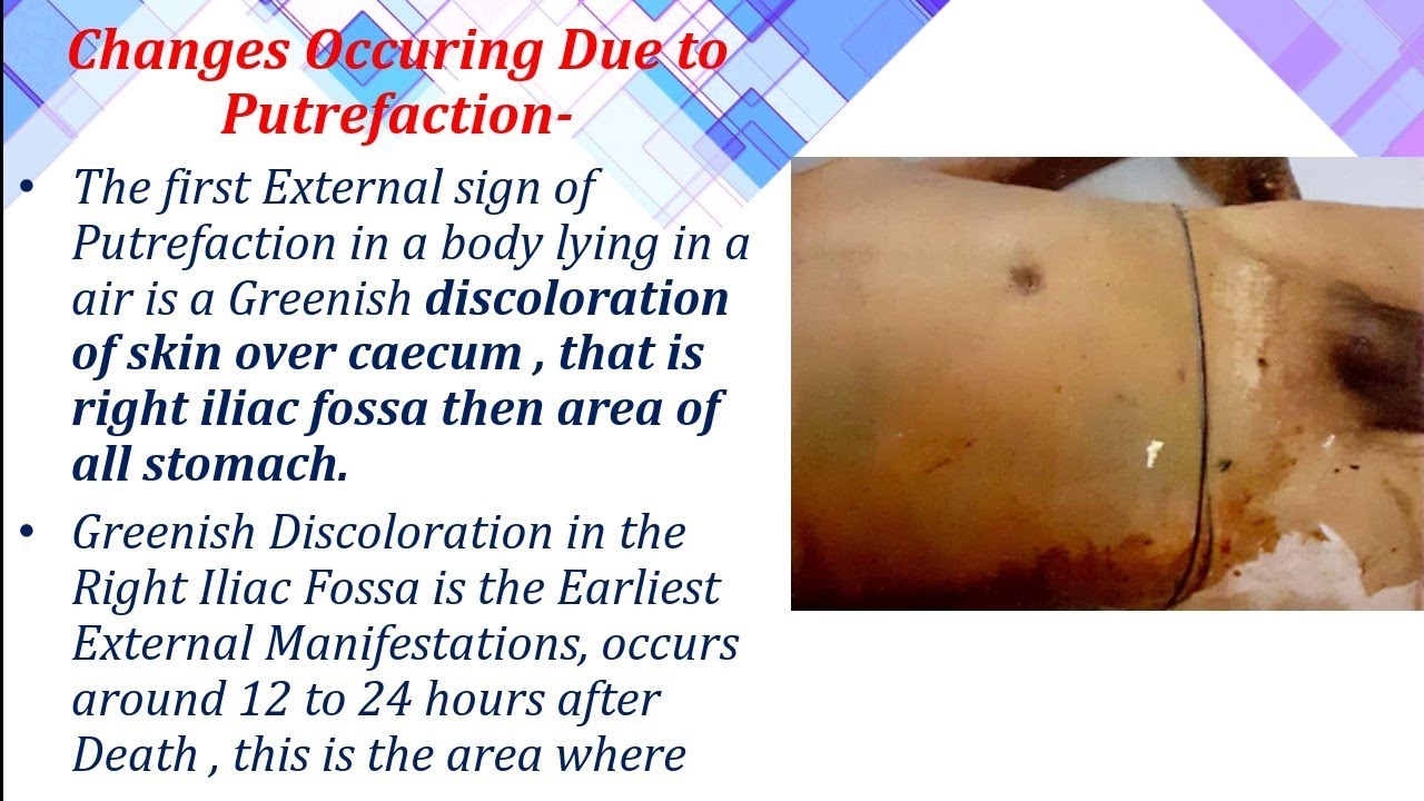 Putrefaction in detail ( 1st late sign ) YouTube