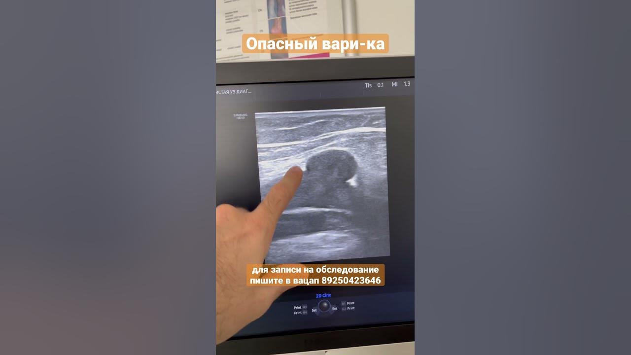 Варикс подколенной вены. Узи вен. Флеболог Москва. Флеболог. Сосудистый ...