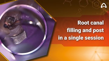 Single cone technique and post preparation in a single session | BIO-C Sealer