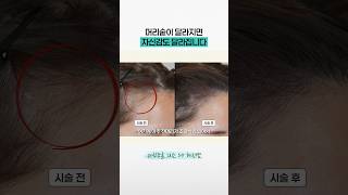 자신감을 채우는 여자 두피문신 실제 후기✨ 머리숱, 헤어라인, 가르마 커버