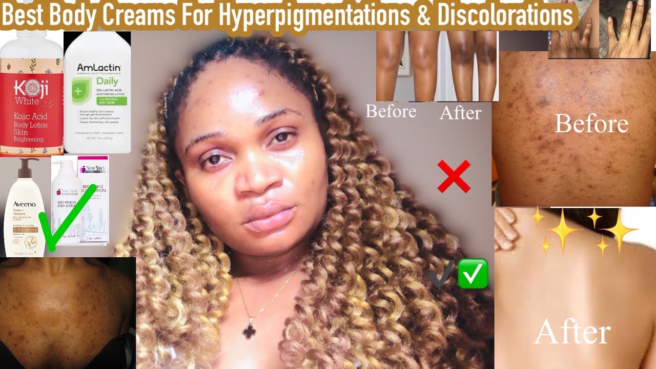 Most Effective Body Creams For Pigmentation And Skin Discoloration