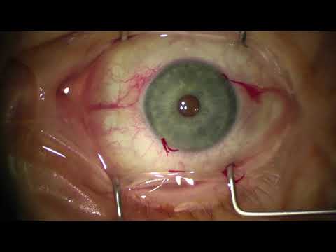 DMEK (Descemet's Membrane Endothelial Keratoplasty) by Dr. Mark C. Vital at Houston Eye Associates