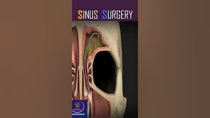 Ballon Sinuplasty, Sinus Surgery #shorts