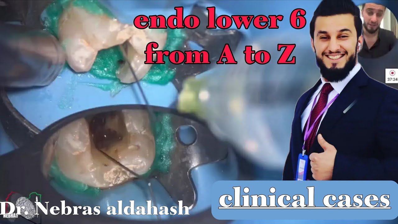 Endodontic case | lower 6 from access to Obturation | Dr.Nebras Aldahash 