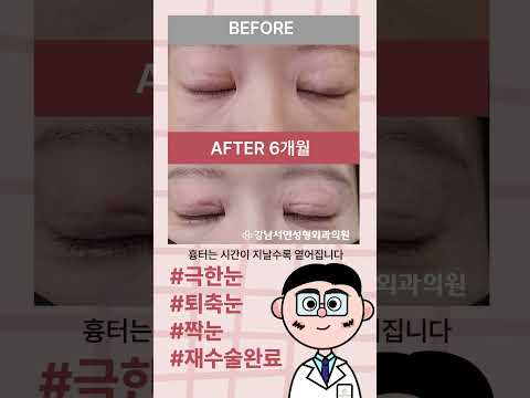 극한 퇴축 짝눈 재수술 전후
