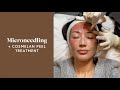 Microneedling Treatment & Cosmelan Peel For My Melasma! | Susan Yara