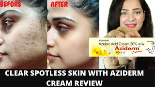 Aziderm cream | Aziderm cream review | aziderm cream 10 | aziderm 10 gel | azelaic Acid | scars,mark