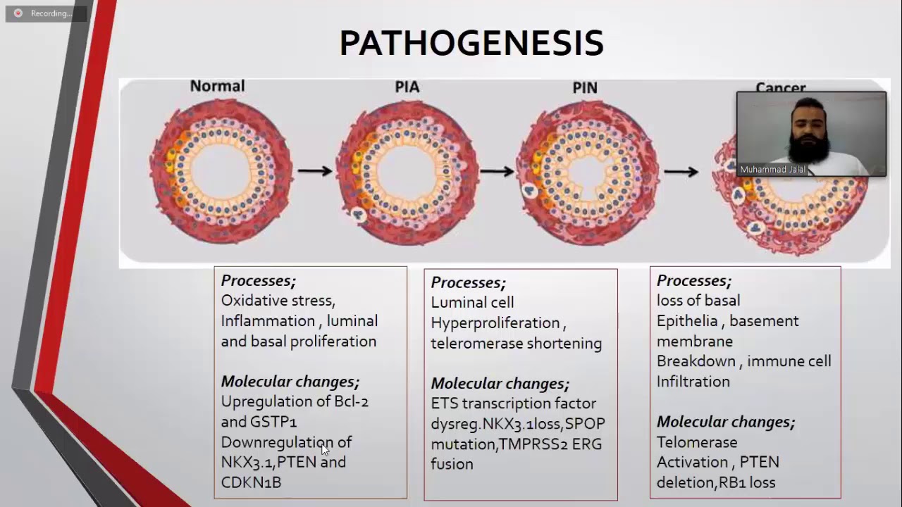 MS Urology Online Presentations: Metastatic Hormone Refractory Prostate Cancer