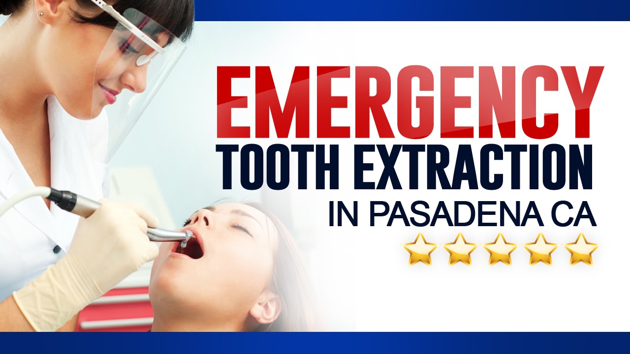 Emergency Tooth Extraction in Pasadena CA - (626) 795-0221 ... Emergency Tooth Extraction in Pasadena CA - (626) 795-0221 ...