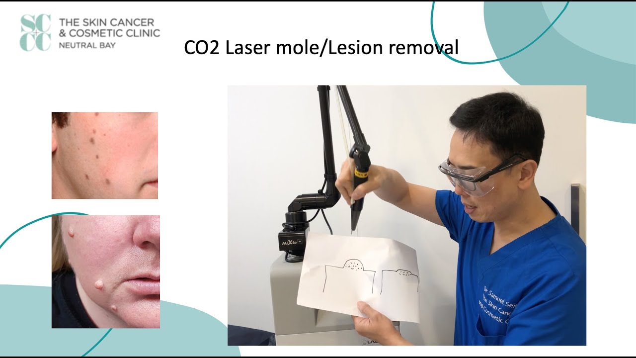 Laser Mole removal at the SCCC