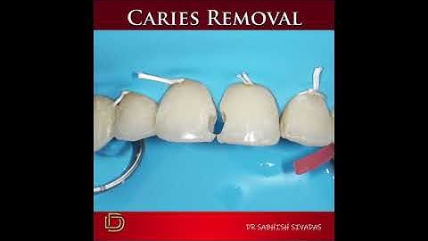 Anterior BIoclear Restoration