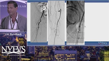 Access and Crossing Technique in SFA CTO Intervention   J  H  Rundback   PAD Session