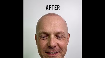 The Best before & after Scalp Micropigmentation Treatment & Training