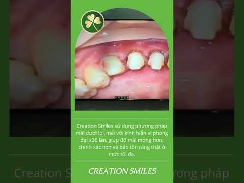 Q&A 07: Creation Smiles bọc sứ như thế nào để không bị viêm lợi?