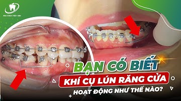 [Bạn Có Biết] Bác Sĩ Chỉnh Nha Đánh Lún Răng Không Dùng Minivis Như Thế Nào?
