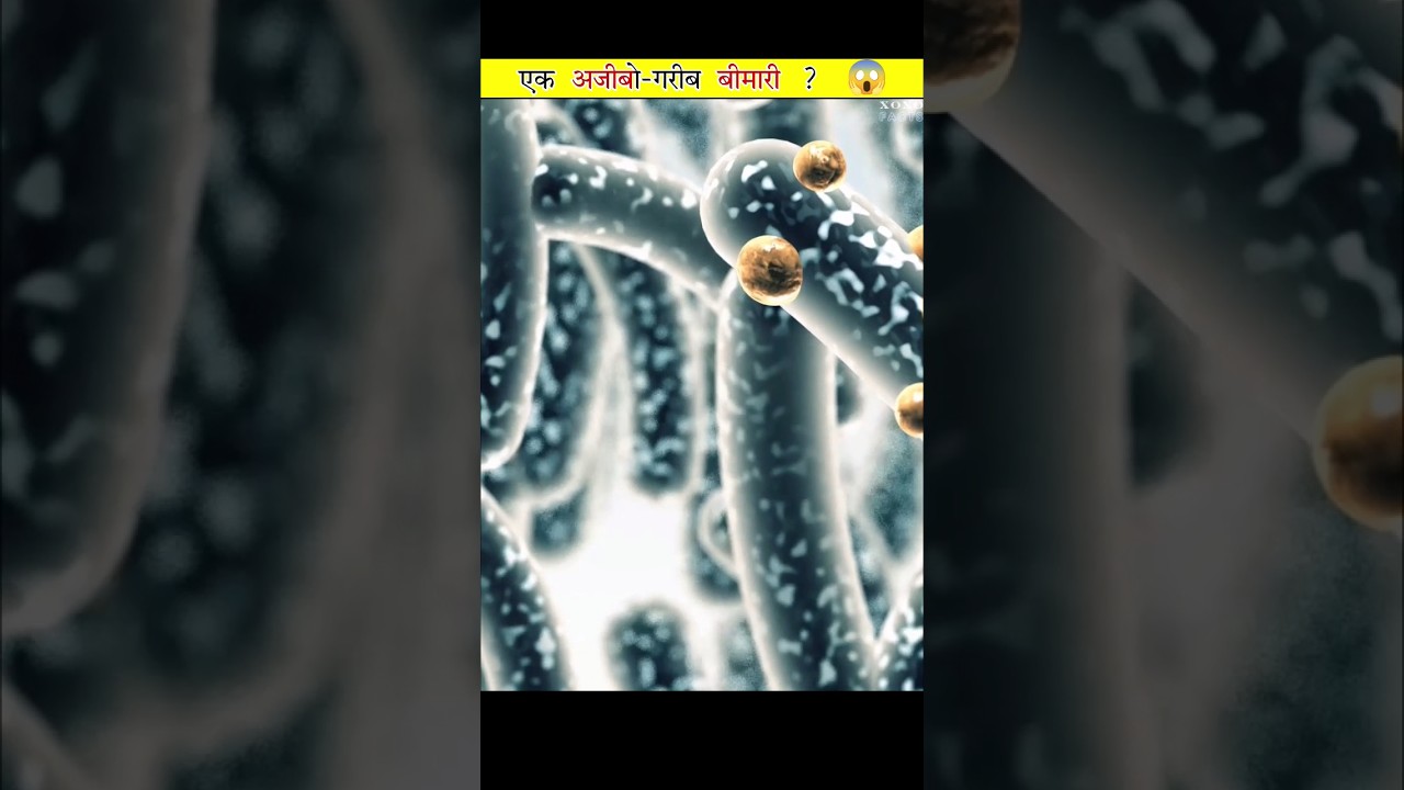 AutoBrewery Syndrome Disease facts shorts viral alcohol YouTube