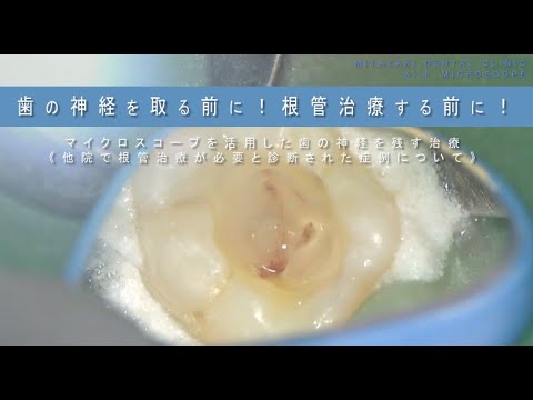 きがるな根管処置法 PARTー2 きがるな根管処置法 PART