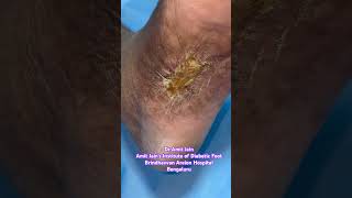 #callus #calices #cornsandcalluses #corn  #foot | Best Podiatrist in Bengaluru | Dr Amit Jain