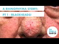 A Rhinophyma Story: Part 1 - Blackheads!