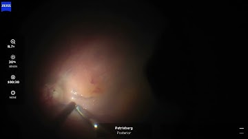 Switching the endoillumination