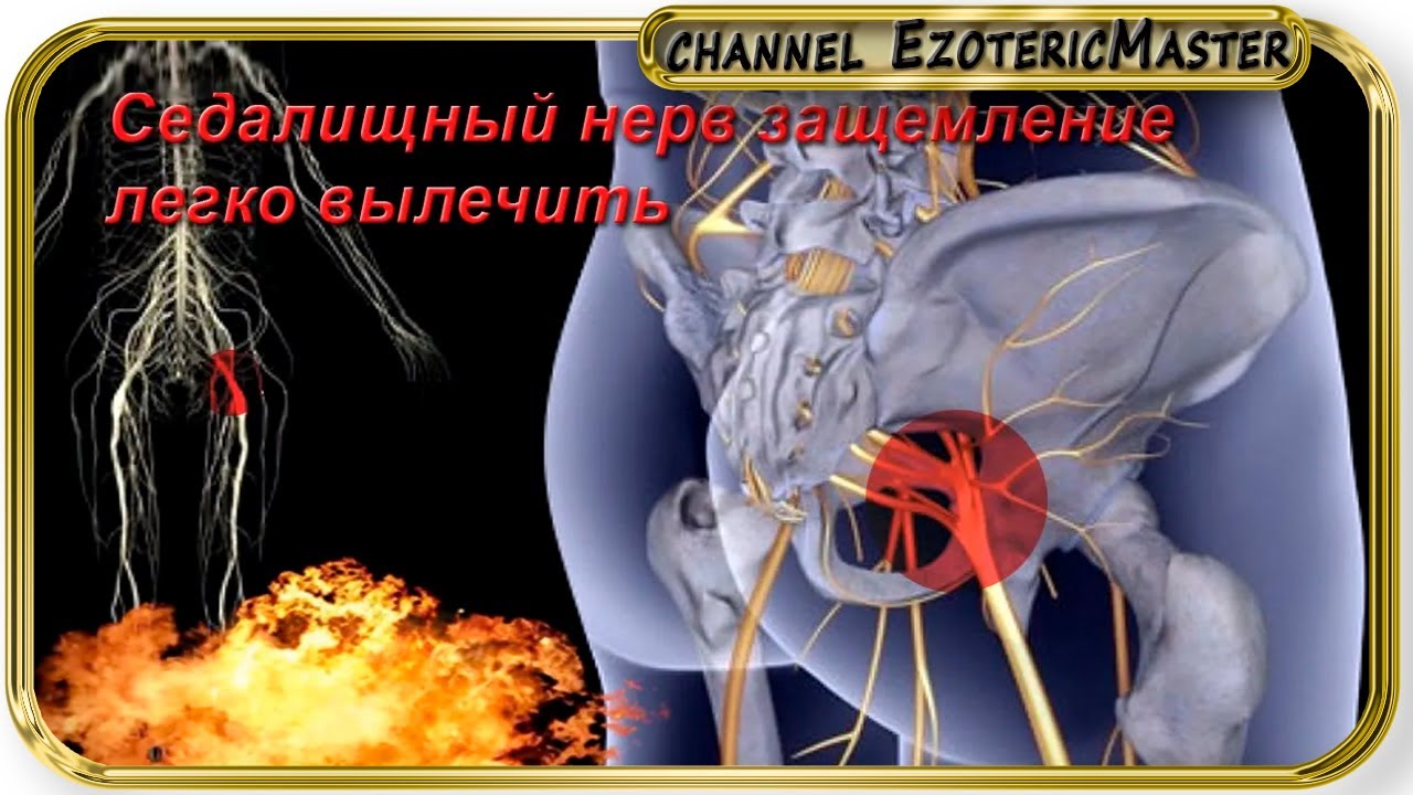 Как вылечить защемление седалищного нерва. Боль при защемлении седалищного нерва. Воспаление воспаление седалищного нерва.