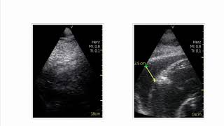 How To Look For a Pericardial Effusion In an Echocardiogram