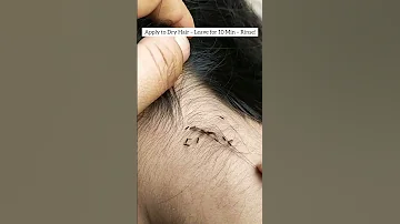 Lice Removal Get Rid Of Lice And Nits Liceremoval Licecomb Licetreatment Liceremoval Piojos 