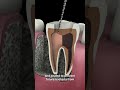 ROOT CANAL TREATMENT SAVED THIS TOOTH 🦷✨ #dentist #dentalcare #dentalclinic