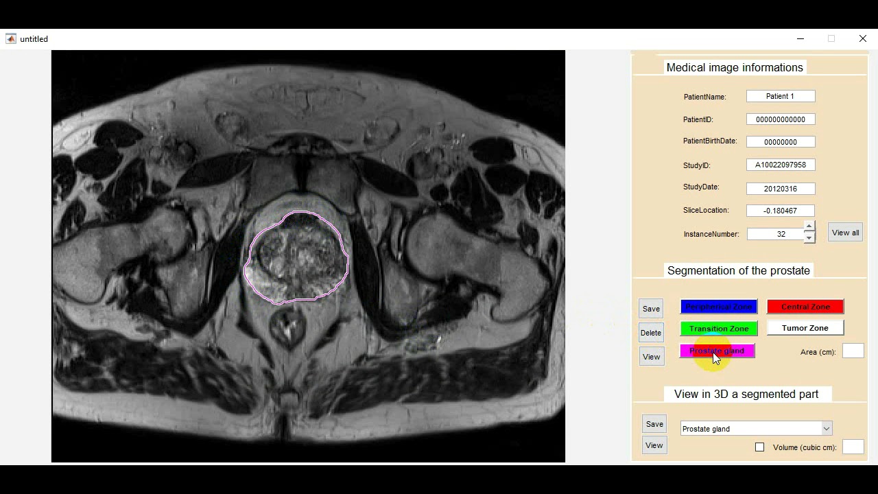 Management and Post-Processing of Prostate MRI - YouTube
