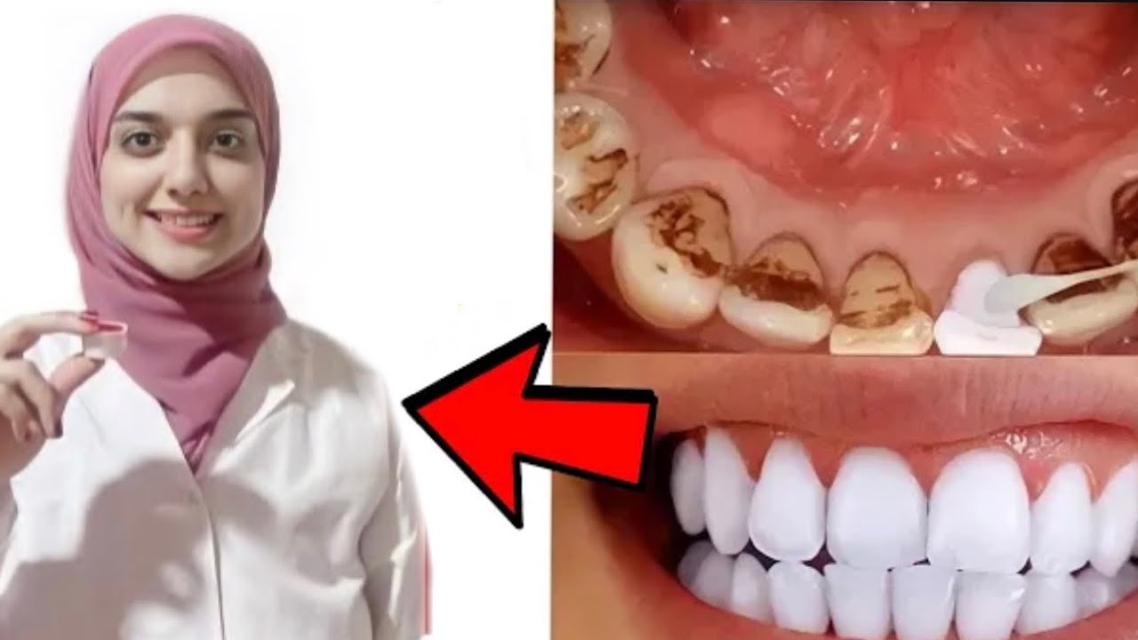 أسرع وصفة لتبييض الاسنان في المنزل و التخلص من التصبغات و الاصفرار و الجير بأمان