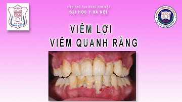 VIÊM LỢI VÀ VIÊM QUANH RĂNG | Bài giảng Nha chu - Răng Hàm Mặt | Sau đại học - Đại học Y Hà Nội