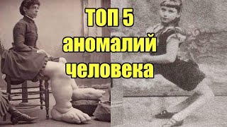 Топ 5 Людей В Истории С Врожденными Аномалиями | ИНТЕРЕСНЫЕ ФАКТЫ