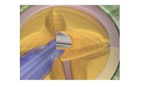 Basics of Phaco - Part II (follow quickguide.org) for Part III the link is given in description box.