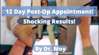Bunion Surgery Recovery  #footsurgery #footpainrelief #bunions #bunionsurgery