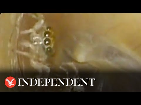 Tiny spider discovered deep inside woman's ear