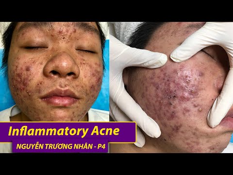 Video Inflammatory Acen | Điều trị mụn hiệu quả số 1 TPHCM |... - youtube
