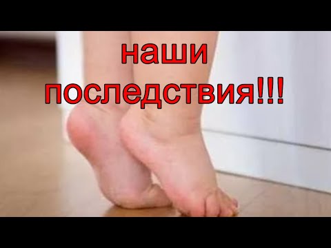 Ребенок начал ходить на носочках это проблема? | наши последствия