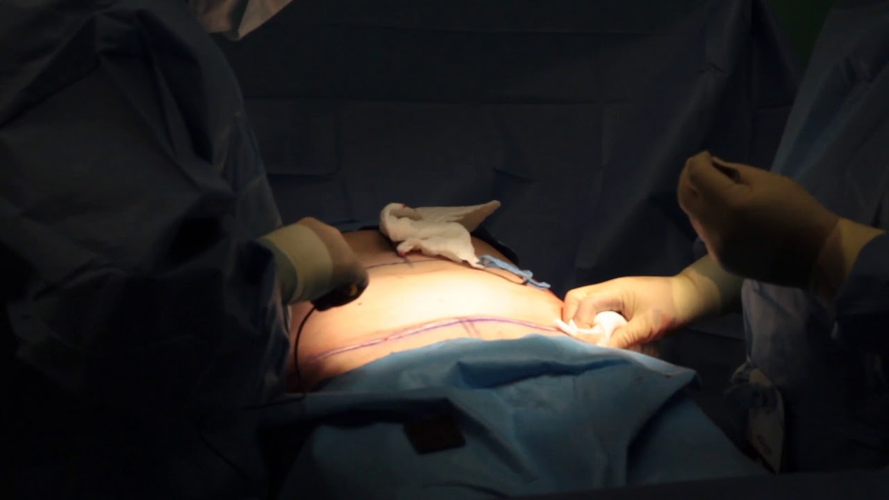 center for reproductive rights Abdominoplastia Part 2 || Juventus Cosmetic