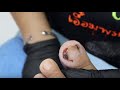 EP_1108 Infected ingrown toenail removal 👣 มันรอ..จนระเบิด 😷  (This clip from Thailand)