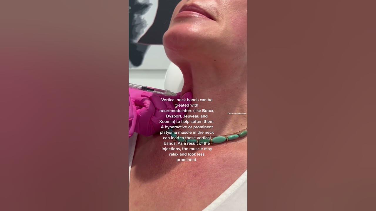 Botox neck bands platysmal bands botox shorts youtube
