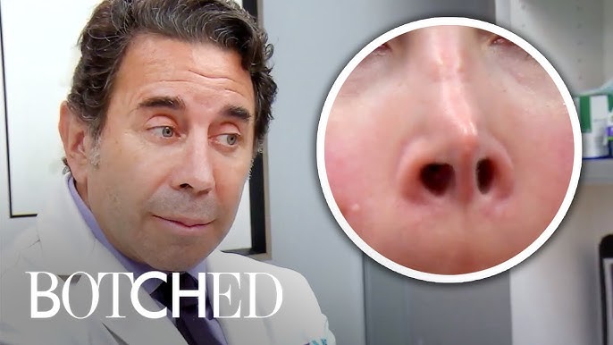 Botched' doctor Paul Nassif sued for alleged nose job error - National