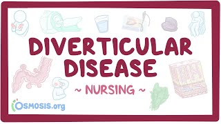 Diverticular disease: Clinical Nursing Care