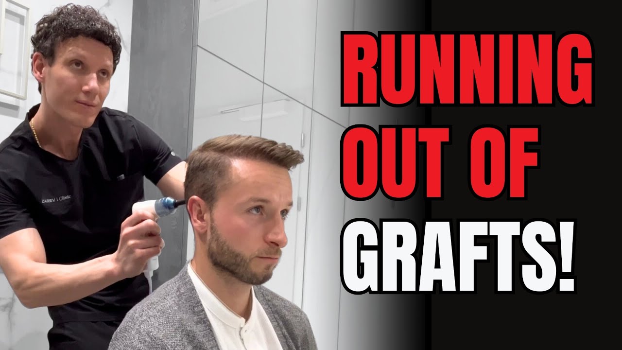 Сколько графтов осталось после трёх FUE? Доктор Зарев