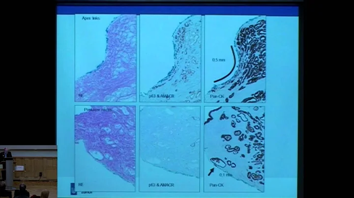 Quality assurance in RP: expanded pathological criteria of surgical resection. T Sulser, Zrich