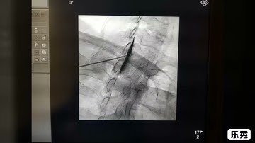 Cervical Epidural Injection