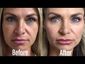 Dermal Filler Cheek Restoration Restylane Defyne