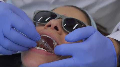 What is IPR (shaving between your teeth) for Invisalign for aligners?