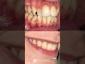 Aparelho Autoligado transformando mais um sorriso! #campinagrande #dentista #odontologia