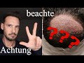 Finger Weg von einer Haartransplantation bei diesen Punkten !