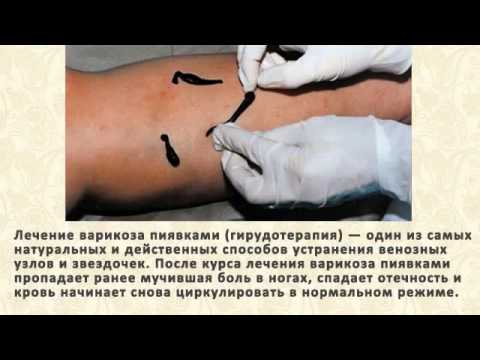 Варикоз ног лечение в домашних условиях